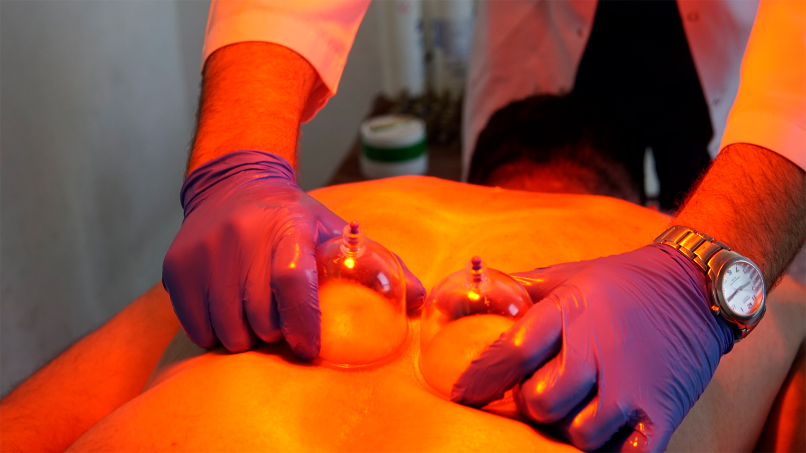 Kupa Tedavisi - Hacamat